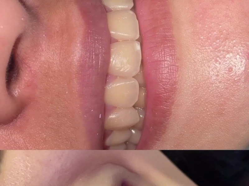 Foto de Dra Taísa Santos - Dentista- Clareamento - Aparelho invisivel sousmile - Porto Velho-Ro
