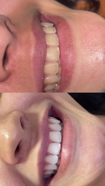 Foto 2 de Dra Taísa Santos - Dentista- Clareamento - Aparelho invisivel sousmile - Porto Velho-Ro