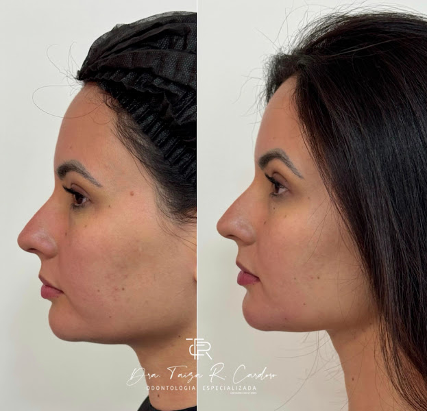 Foto 4 de Dra.Taiza R. Cardôso/Harmonizaçāo Facial/Aparelho Invisalign/Lentes de Resina/Botox Rosto/Clínica Odontológica/Em Palmas
