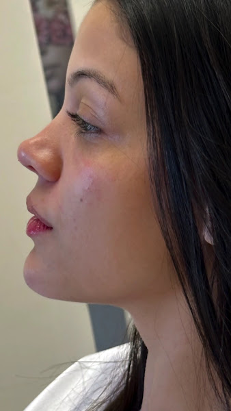 Foto 3 de Dra Talissa Chadud especialista em Harmonização Facial Luziânia