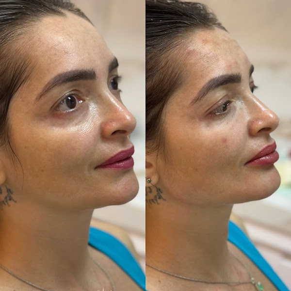 Foto 3 de Dra. Talita Cardoso | Harmonização Facial