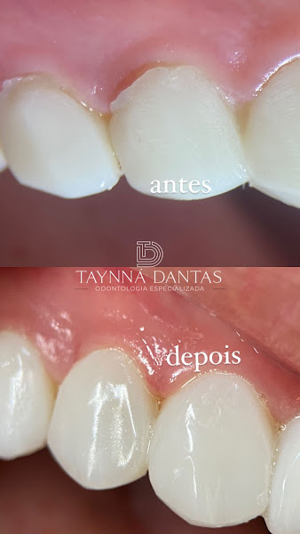 Foto 2 de Dra Taynna Dantas - Dentista, Odontologia, Campina Grande, Facetas em Resinas