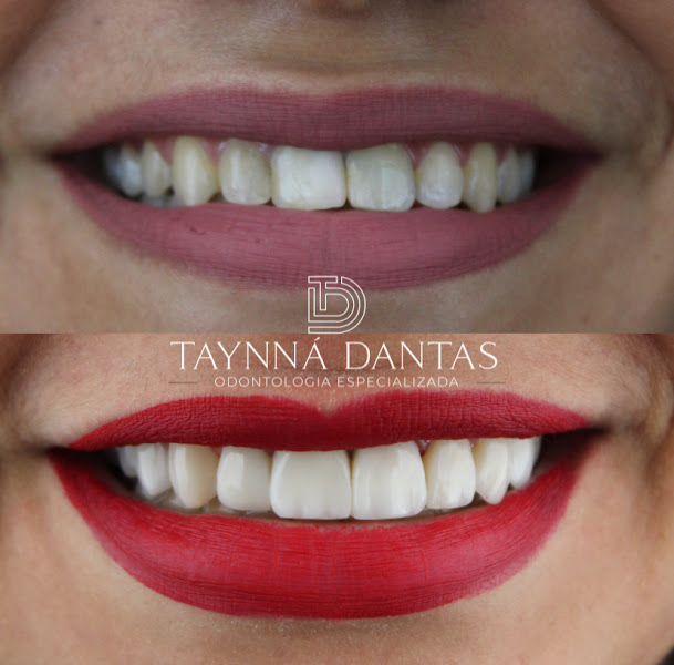 Foto 3 de Dra Taynna Dantas - Dentista, Odontologia, Campina Grande, Facetas em Resinas
