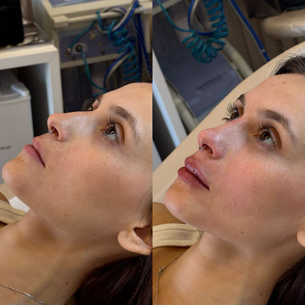 Foto 2 de Dra Thaís Sacomani - Harmonização Orofacial