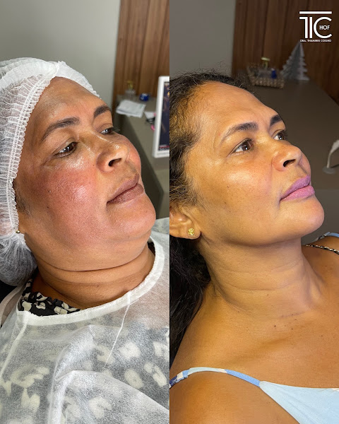 Foto 2 de Dra. Thamires Coelho - Lipo de Papada | HOF