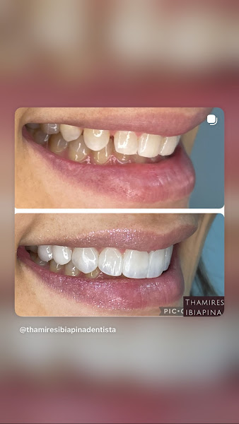 Foto 3 de Dra Thamires Ibiapina Dentista