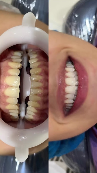 Foto 3 de Dra. Thamires Sátiro - Implantes e prótese dentária em Patos-PB