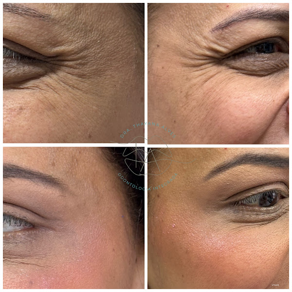 Foto 2 de Dra Thayana Alves - Harmonização facial