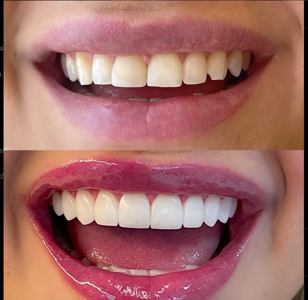 Foto 2 de Dra Thayna Santos | Lentes em Resina Premium - Goiânia | Facetas em Resina