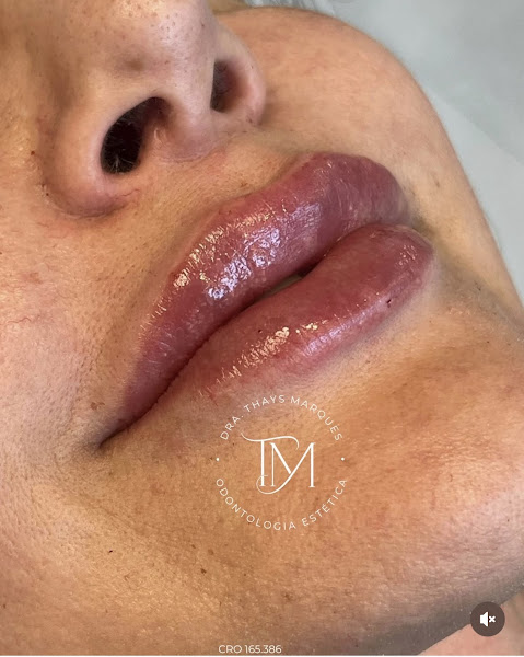 Foto 3 de Dra. Thays Marques - Harmonização Orofacial e Odontologia Estética