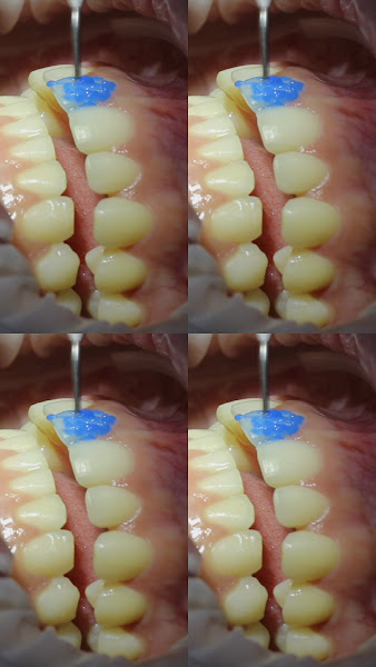 Foto 3 de Dra Vanessa Bitencourt - Odontologia estética (Lente de contato dental e faceta de porcelana)