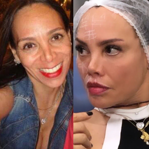 Foto de Dra Vanessa Caselato | Lipo de Papada