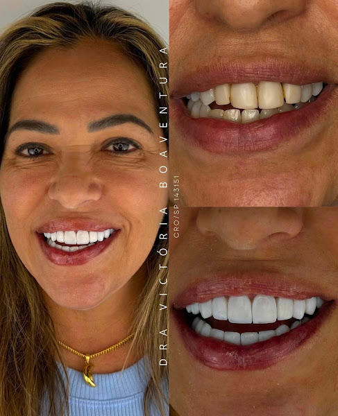Foto 2 de Dra Victória Boaventura - Dentista Marilia - Ortodontia - Alinhador invisível SouSmile - Lentes em Resina