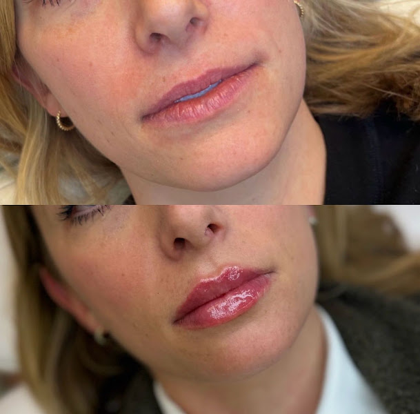 Foto 2 de Dra. Vitória Hagge | Cirurgiã Dentista | Referência em Preenchimento Labial | Especialista em Harmonização Orofacial