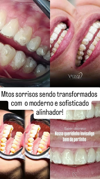Foto 3 de Dra. Viviane Nogueira - Dentista ✨✨ Invisalign Doctor✨✨ Alinhadores Estética