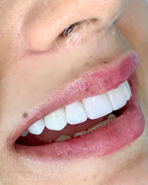 Foto 2 de DRA. WANESSA MELO | DENTISTA RECIFE | HARMONIZAÇÃO FACIAL RECIFE