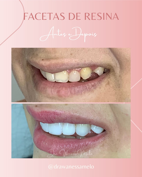 Foto 3 de DRA. WANESSA MELO | DENTISTA RECIFE | HARMONIZAÇÃO FACIAL RECIFE