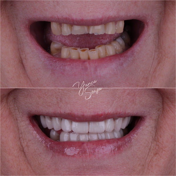 Foto 3 de Dra Yanca Souza - Implantes dentários | Ortodontia | Lentes de contato | Clínico geral.