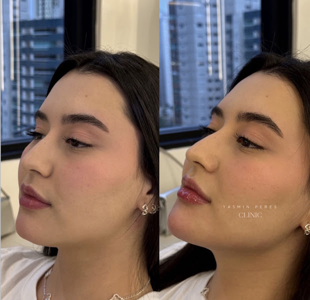 Foto 2 de Dra. Yasmin Peres - Harmonização Facial