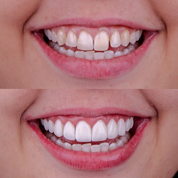 Foto 3 de Dra. Yasmin Spielmann - Dentista Estética – Lentes, Botox e Clareamento | Três Lagoas