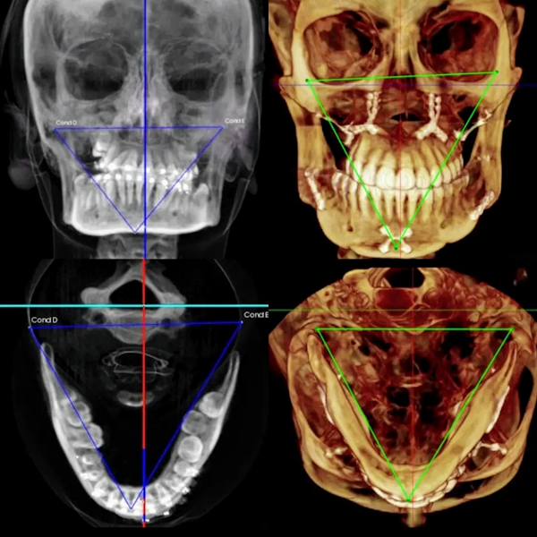 Foto 3 de Eleandro Ianick Ortodontia Reabilitadora - (Aparelho dental, reabilitação oral em palmas, sistema Ertty)