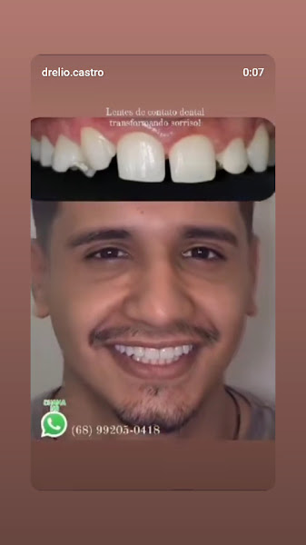 Foto 2 de ELIODONTO: Lentes e contato dental. Clareamento Dental. Aparelhos Ortodonticos