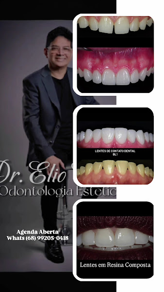 Foto 3 de ELIODONTO: Lentes e contato dental. Clareamento Dental. Aparelhos Ortodonticos