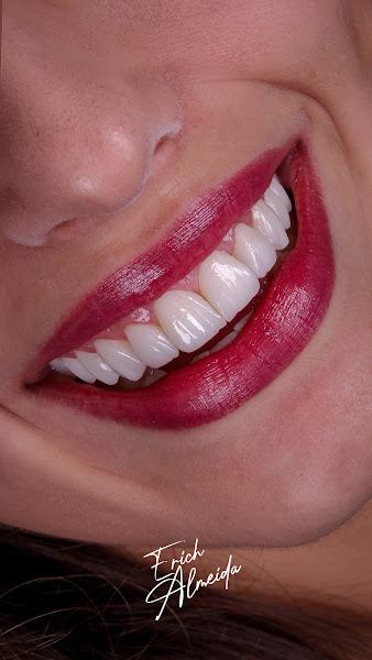 Foto 2 de Erich Almeida - Facetas em Resina e Porcelana