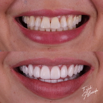 Foto 3 de Erich Almeida - Facetas em Resina e Porcelana