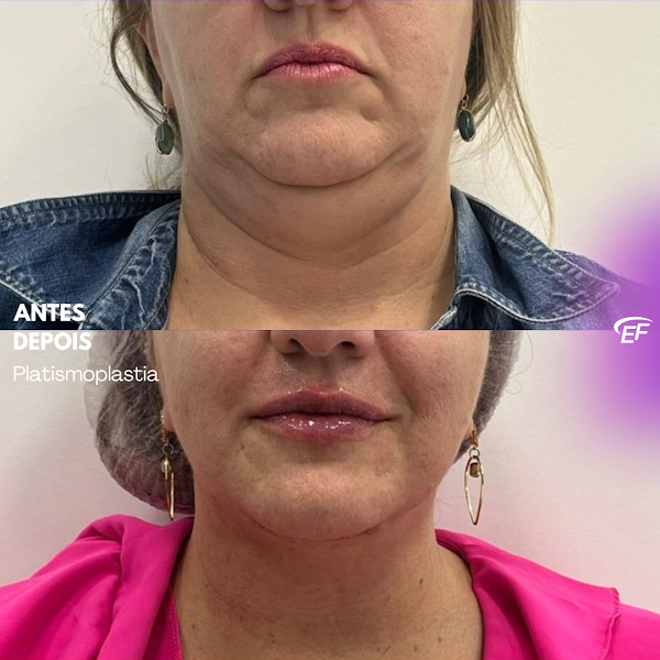 Foto 2 de Estetic Face - Harmonização Facial, Lipo de Papada, Botox e Blefaroplastia em Caxias do Sul