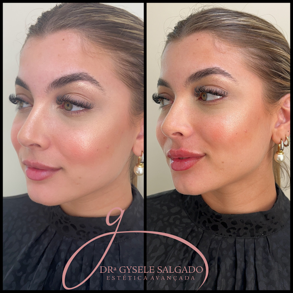 Foto 3 de Estética Avançada Gysele Salgado | Botox