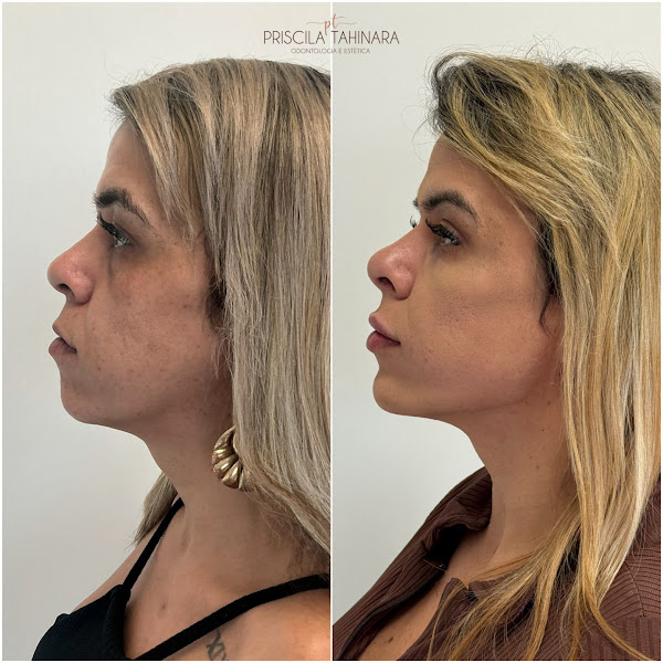 Foto 3 de Estética Dental e Facial | Campinas-SP | Dra. Priscila