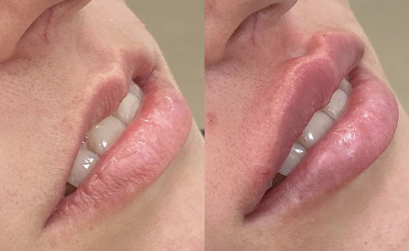 Foto 2 de Estética, Harmonização facial, Botox, Peeling, Microagulhamento
