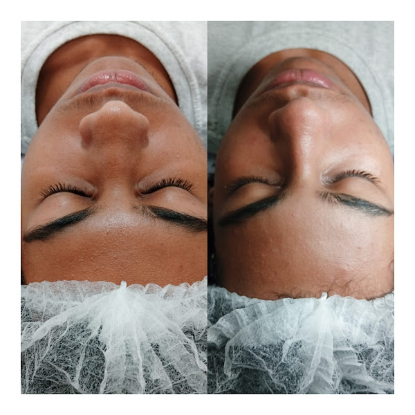 Foto 3 de Estética Luciana Dias /Pós operatório /Drenagem linfática , Limpeza de Pele e Cílios Centro Itapevi SP