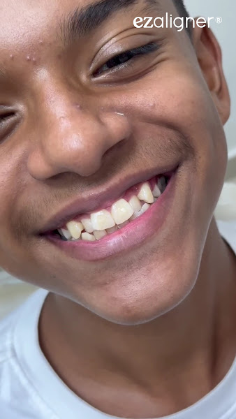 Foto 3 de ezaligner