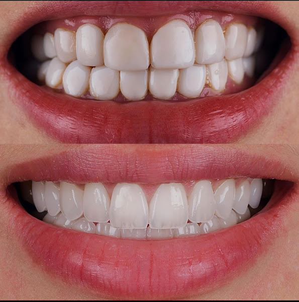 Foto 2 de FaceeBoca : Ultraformer - Botox - Fios Pdo - Implantes Dentários - Lentes de Contato Dental - em Sobradinho, Brasília - DF