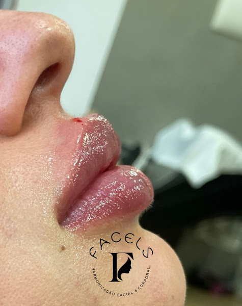 Foto 2 de Facels - Harmonização Facial e Corporal