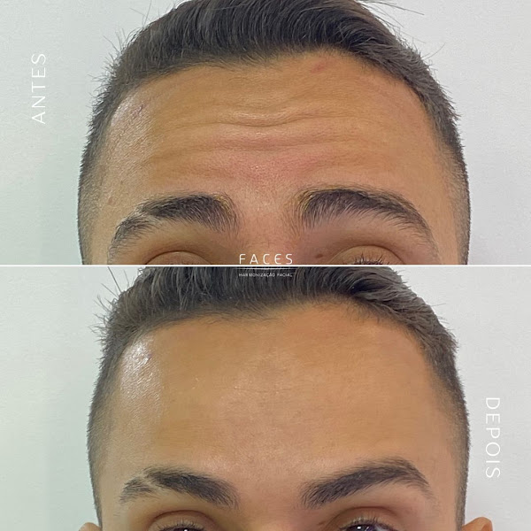 Foto 3 de Faces Harmonização