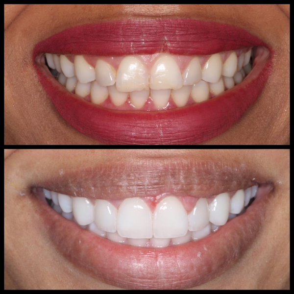 Foto 5 de Faces Odontologia Especializada - Lentes de Contato Dental