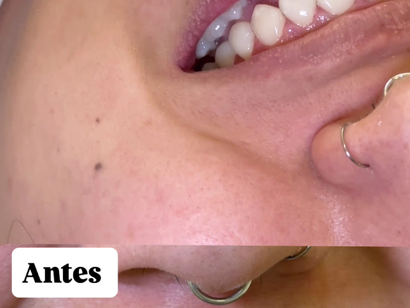 Foto 2 de Faceta de Resina SP