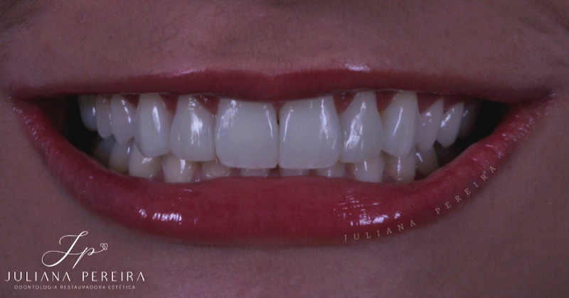 Foto 2 de Facetas em Resina | Dra Juliana Pereira