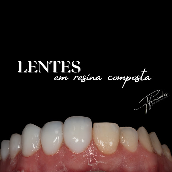 Foto 2 de FACETAS EM RESINA E IMPLANTES DENTÁRIOS EM FLORIANÓPOLIS DRA. FERNANDA FERNANDES