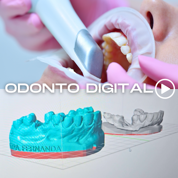 Foto 3 de FACETAS EM RESINA E IMPLANTES DENTÁRIOS EM FLORIANÓPOLIS DRA. FERNANDA FERNANDES