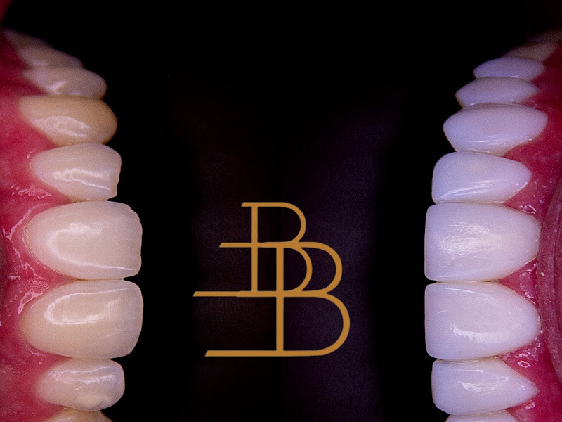 Foto 10 de FACETAS EM RESINA E IMPLANTES DENTÁRIOS EM FLORIANÓPOLIS DRA. FERNANDA FERNANDES