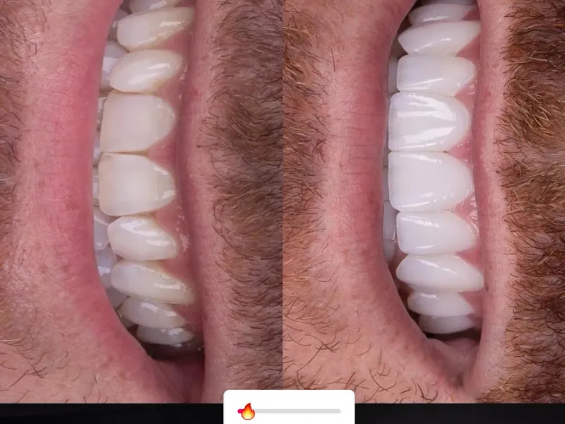 Foto 3 de Facetas em Resina em São Luís - Dr. Alvaro Rocha