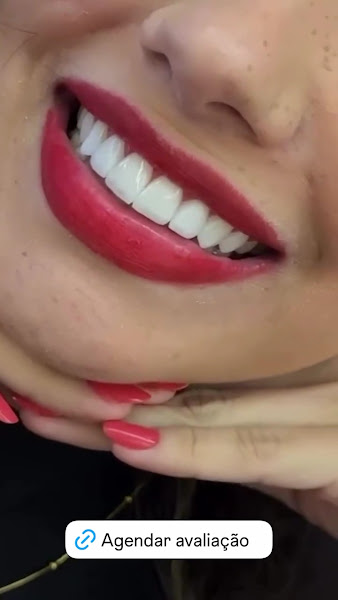 Foto 3 de FACETAS EM RESINA TERESINA | Clínica de Urgência e Estética Odontológica