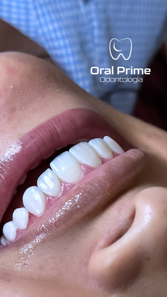 Foto 2 de Facetas em Resina Uberlândia - Oral Prime