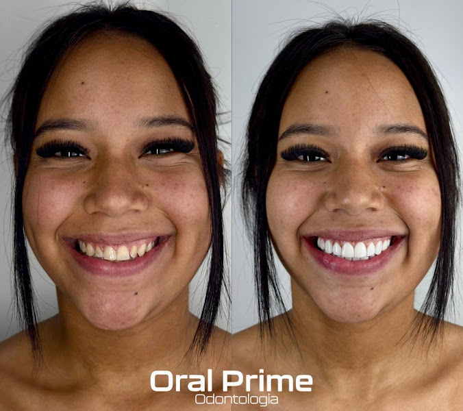 Foto 3 de Facetas em Resina Uberlândia - Oral Prime