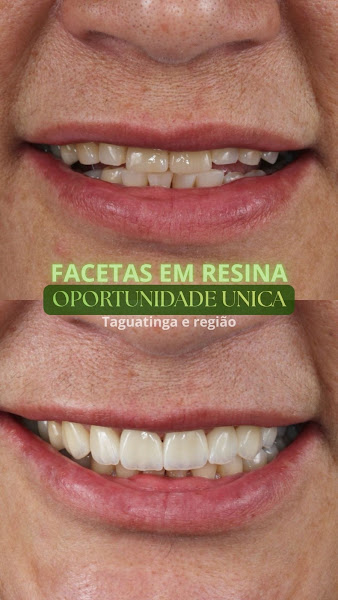 Foto 3 de Facis Odontologia Taguatinga - Implante Dentário, Invisalign, Prótese protocolo, Lente de Contato e Facetas