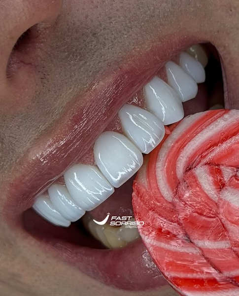 Foto 2 de Fast Sorriso BH Clínica Odontológica, Referência Lentes de Resina/Porcelana, Dentista Vila da Serra - Nova Lima